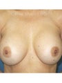 Corrective Breast Imlant Surgery