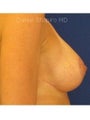 Corrective Breast Implant Surgery