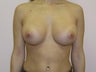 Breast Augmentation