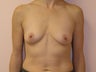 Breast Augmentation