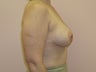 Breast Augmentation with lift