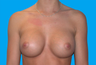 Breast Augmentation
