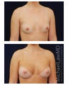 Breast Augmentation