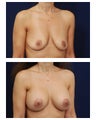 Breast Augmentation