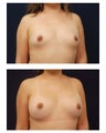 Breast Augmentation