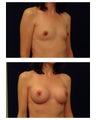 Breast Augmentation