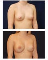 Breast Augmentation