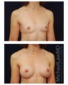 Breast Augmentation