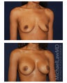 Breast Augmentation