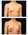 Breast Augmentation