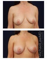 Breast Augmentation