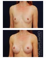 Breast Augmentation