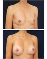 Breast Augmentation