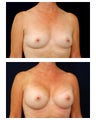 Breast Augmentation