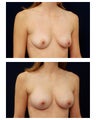 Breast Augmentation