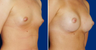 Breast Implants