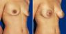 Breast Implants
