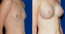Breast Implants