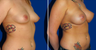 Breast Implants
