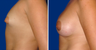 Breast Implants