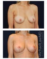 Breast Augmentation with Lift