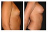 Breast Augmentation