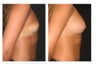 Breast Augmentation