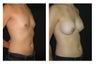Breast Augmentation