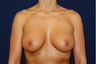 Breast Augmentation