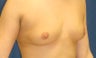 Breast augmentation with saline implants