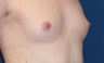 Breast augmentation with saline implants