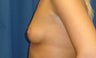 Breast augmentation with saline implants