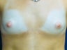 Breast augmentation with silicone gel implants