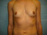 Breast Implants