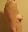 Breast Implants