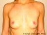 Breast Augmentation