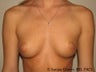 Breast Augmentation