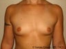 Breast Augmentation