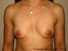 Breast Augmentation