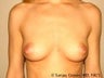 Breast Augmentation
