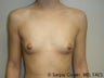 Breast Augmentation