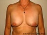 Breast Augmentation