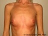 Breast Augmentation
