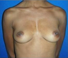 Breast Augmentation