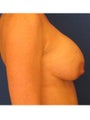 Corrective Breast Implant Surgery