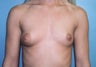 Breast Augmentation + Areola Reduction