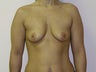 Breast Augmentation