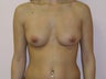 Breast Augmentation