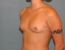 Breast Augmentation