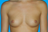 Breast Augmentation
